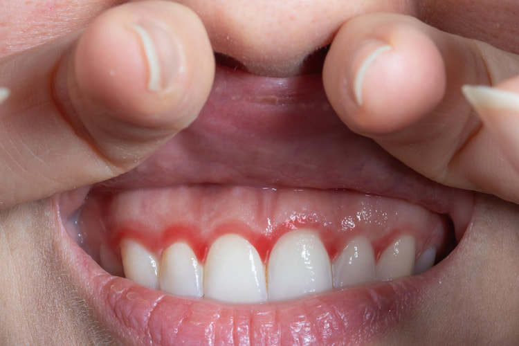 A person pulling up upper lip to reveal inflamed, bleeding gums.