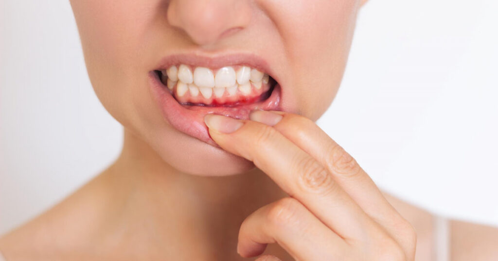 Close-up of person pulling down lower lip to reveal inflamed gums as one of Gum Disease Symptoms.