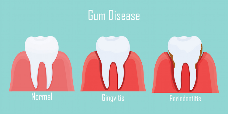 two types of gum disease shown: a normal gum, gingivitis, and periodontitis. 