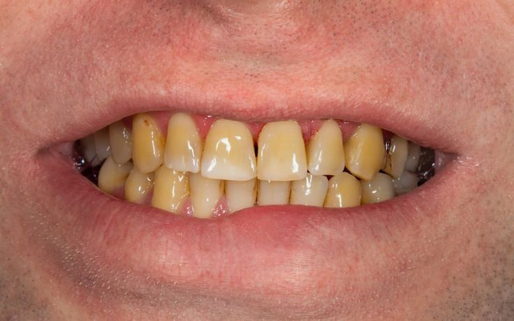 teeth that have become yellow because of drinking coffee