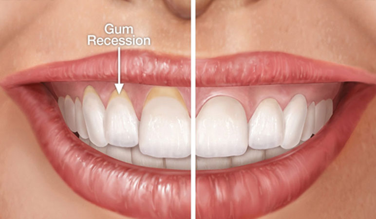 What Is Gum Recession and Why It Matters