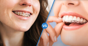 Close-up image of teeth showing Invisalign vs braces, with clear aligners positioned next to traditional metal braces for comparison.