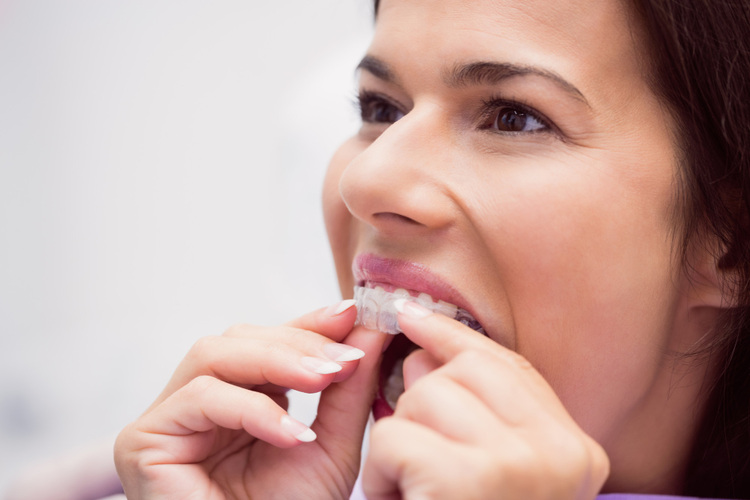 A smiling woman happily placing Invisalign clear aligners into her mouth.
