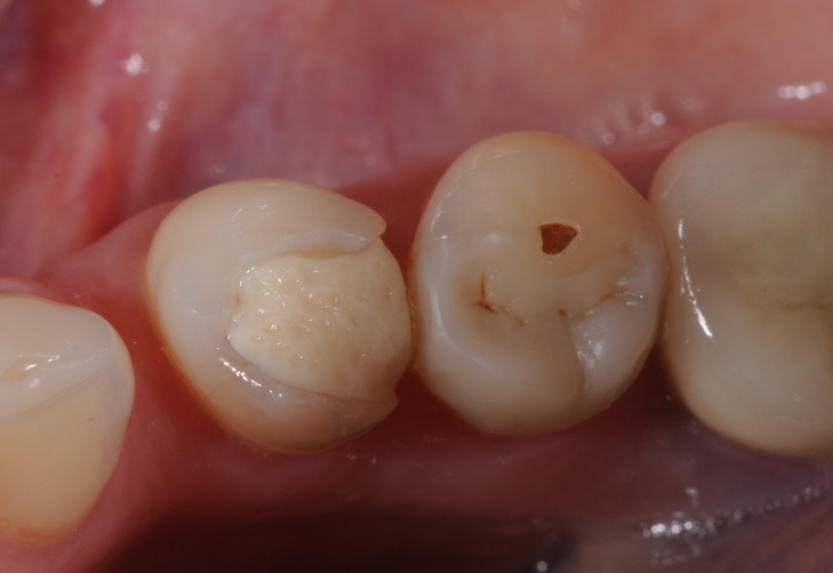 Close-up of poor dental filling, one of the main dental fillings failure causes.