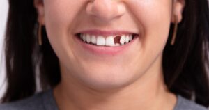 Close-up of a young woman’s face showing a missing tooth in her smile