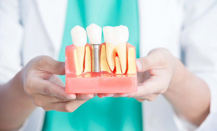 Dentist’s hands holding a dental implant model close to the camera, number one solution for missing tooth replacement