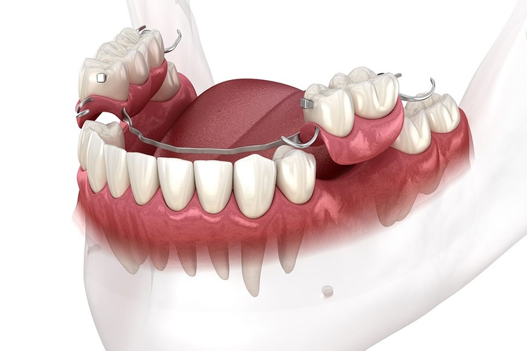 Vector illustration of dental dentures as a solution for replacing missing teeth