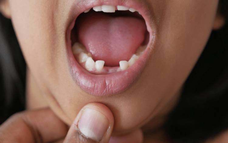 Tips on saving a knocked out tooth