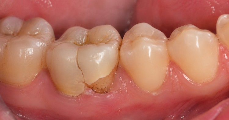 Close-up of teeth showing a severely cracked tooth in a dental emergency situation.