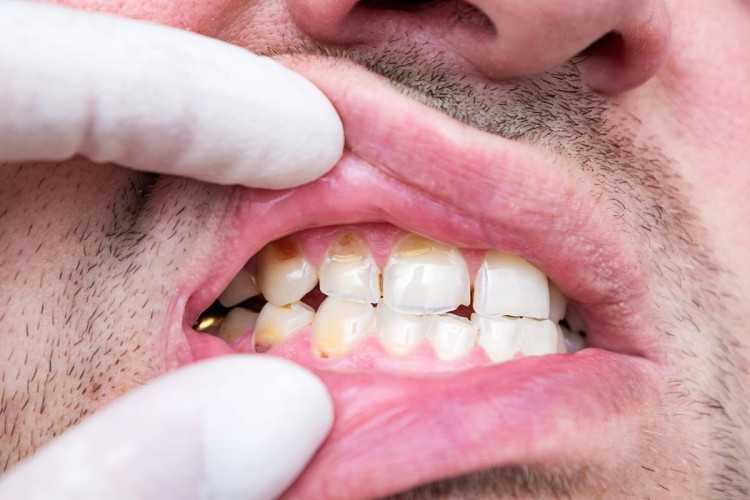Close-up of a man’s mouth and teeth, with a dentist gently using fingers to slightly open his mouth, revealing untreated tooth decay and signs of gum issues.