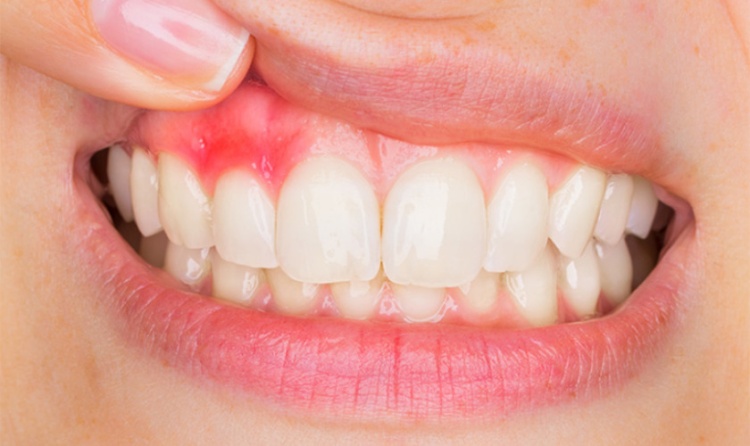 Close-up of teeth and gums showing gingivitis, with red, inflamed gum tissue indicating early gum disease and poor gum health.