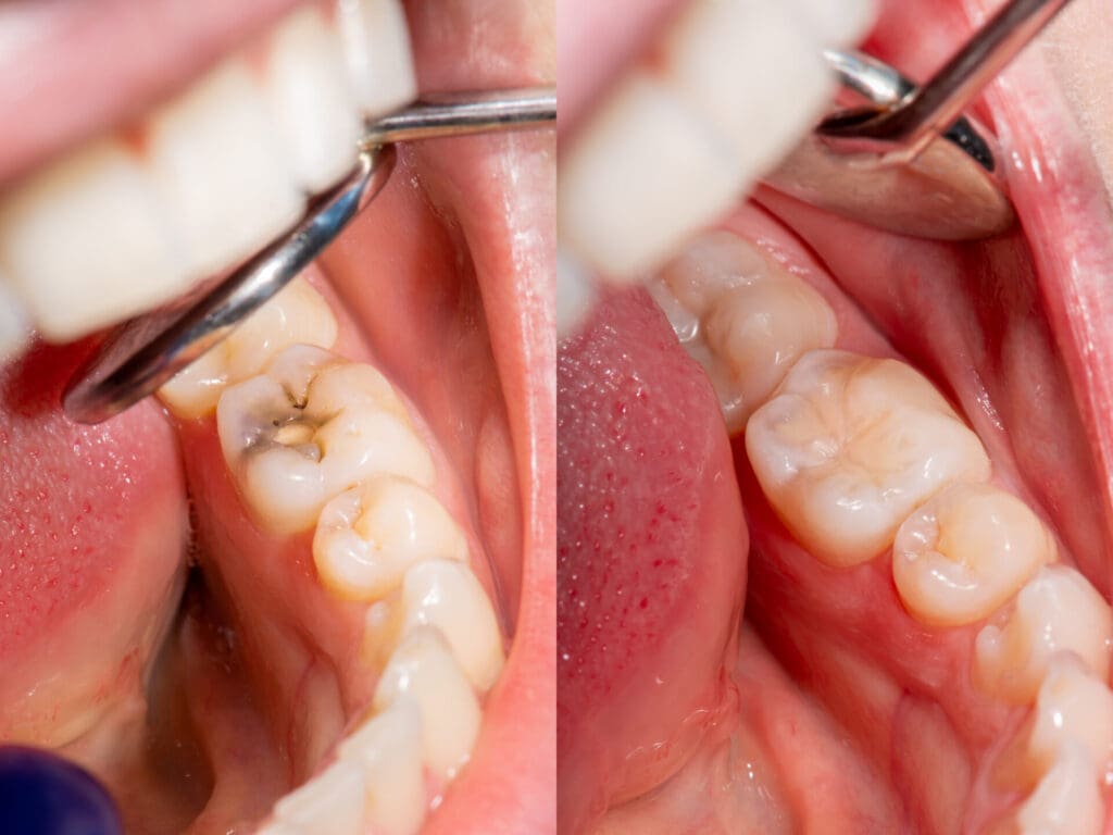 Dental Filling toronto