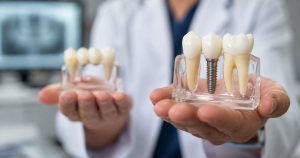 Dentist holding a dental implant and bridge model side by side to compare a dental implant instead of a bridge for replacing a missing tooth.
