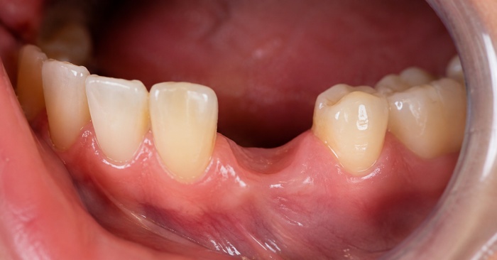 Close-up of a missing tooth with healthy neighboring teeth, showing an ideal situation for a single dental implant.