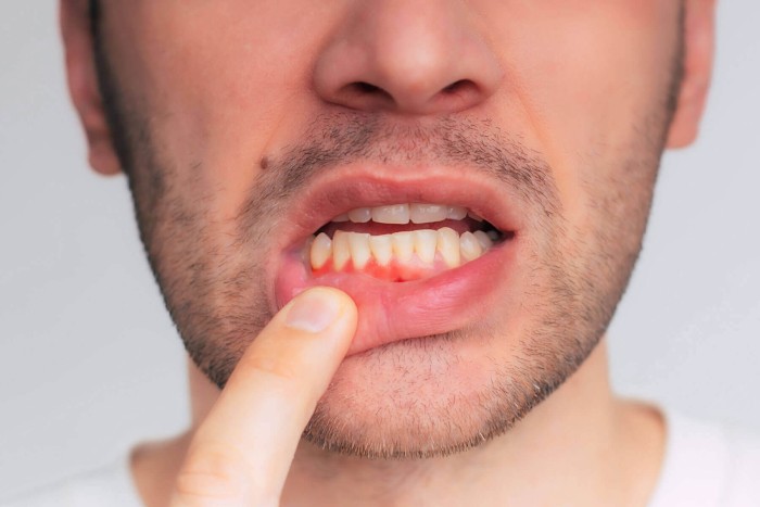 A close-up of a man’s lower teeth showing gum recession, one of the causes of sudden tooth sensitivity to sweets