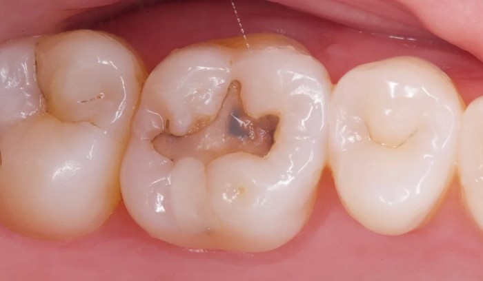 Early stage of cavity formation which can cause tooth sensitivity to sweets